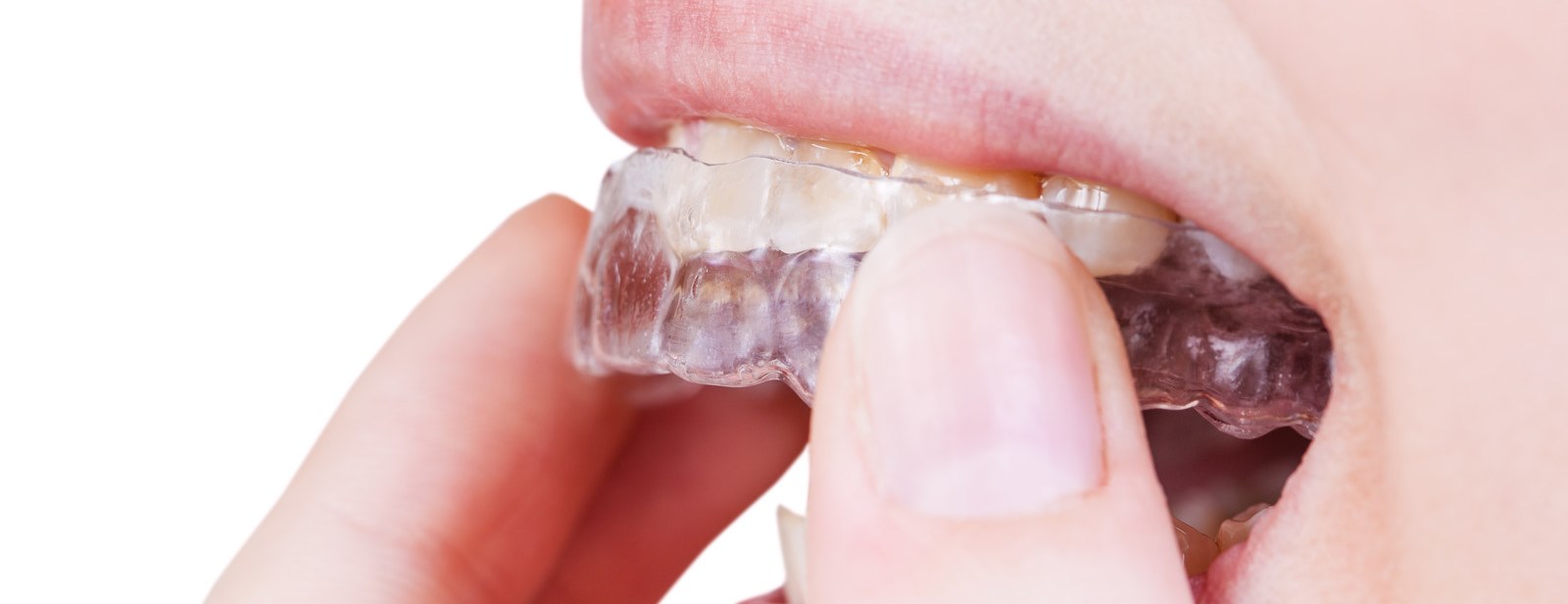 Ortodonzia Invisibile Mascherine Invisalign